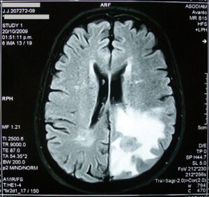 Diagnosing the Living: The Scientific Breakthrough the NFL Is Watching Closely