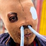 Colombian Acid Attack Survivor Formally Requests Euthanasia After 26 Years of Pain and More Than 80 Surgeries