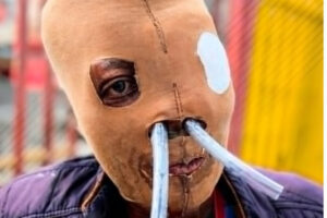 Colombian Acid Attack Survivor Formally Requests Euthanasia After 26 Years of Pain and More Than 80 Surgeries