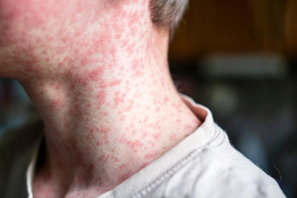 The CDC Says One Person Died of Measles This Year. Pennsylvania Reported Four and the CDC Will Not Count Them.